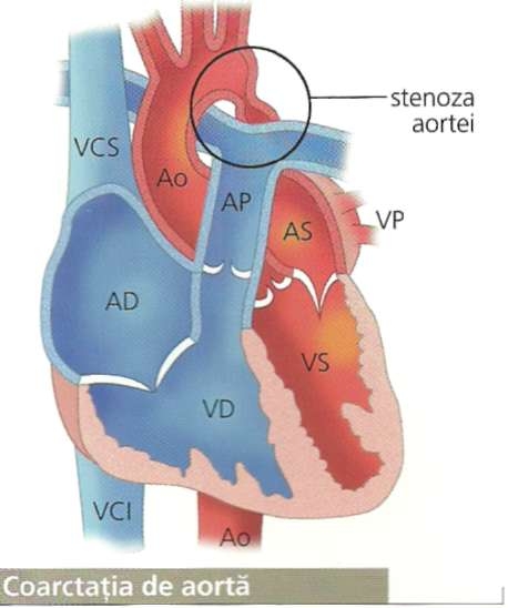 Cardiopatiile congenitale cu sunt arteriovenos